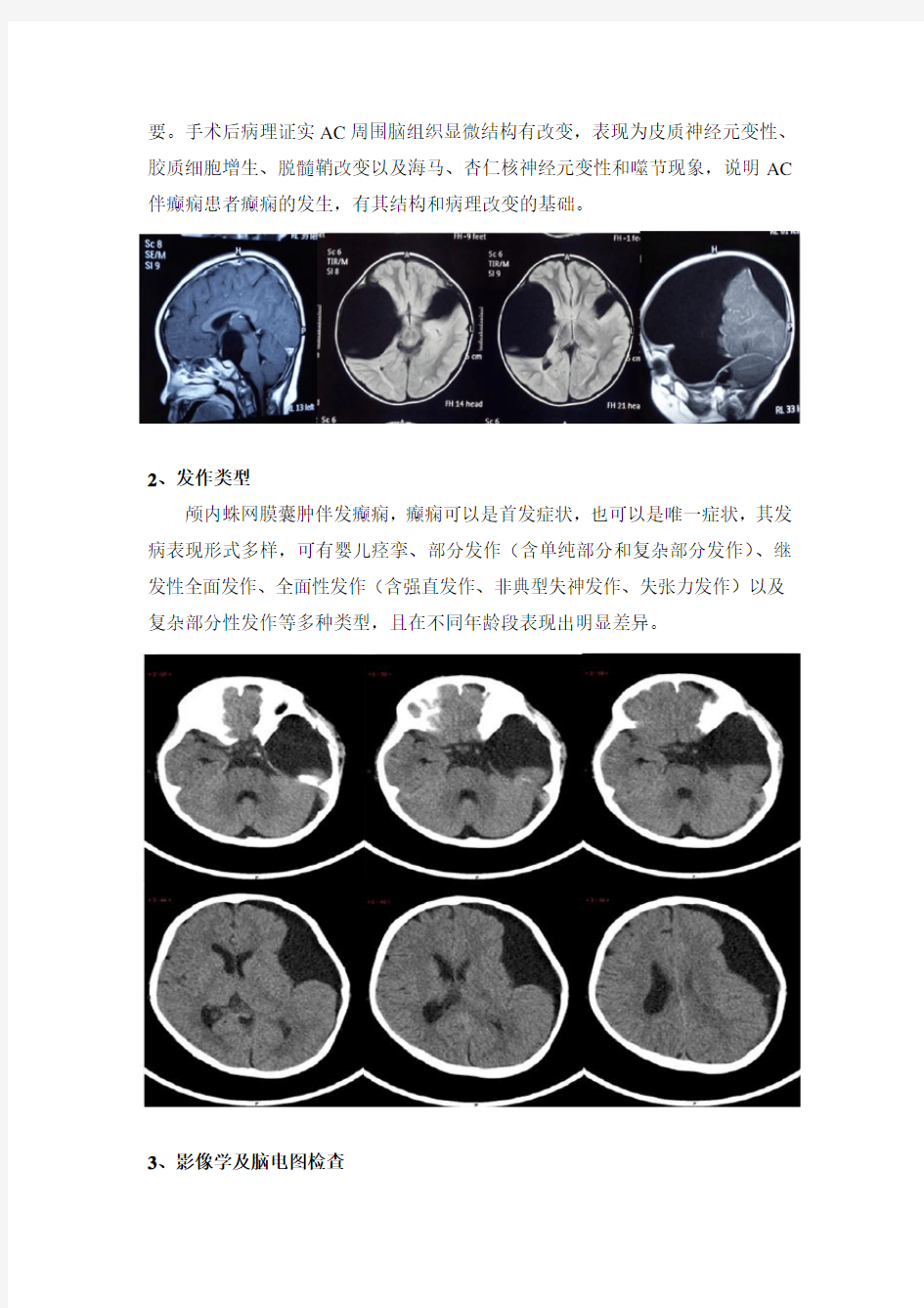 蛛网膜囊肿与癫痫